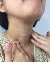 角質ピーリングでくすみ取り効果がわかる首