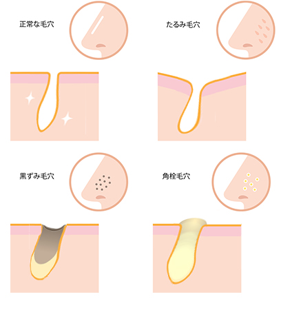 毛穴のトラブルのイメージ