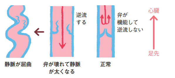 下肢静脈瘤の発生