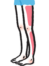 細い血管がクモの巣のように透けて見えるクモの巣状静脈瘤が現れやすい。