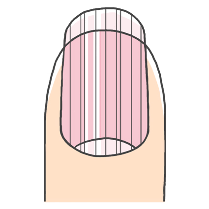 爪の縦筋