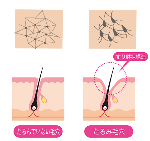 たるみ毛穴のイメージ