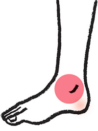 3~4㎜の血管がぼこぼこと浮き出る伏在静脈瘤や分枝静脈瘤が現れやすい。